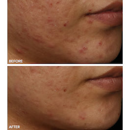 Before and after results using FaceWare Pro - LED Face Mask for glowing skin.