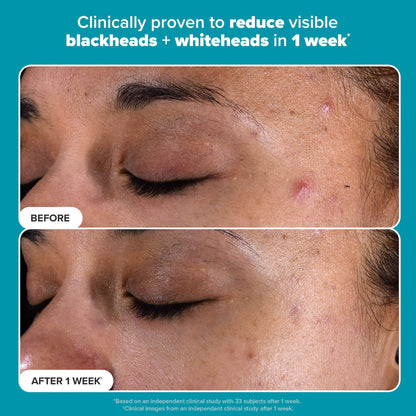 Skin Perfecting 2% BHA Exfoliating Toner Pads for Clear Skin reduce blackheads and whiteheads in 1 week.